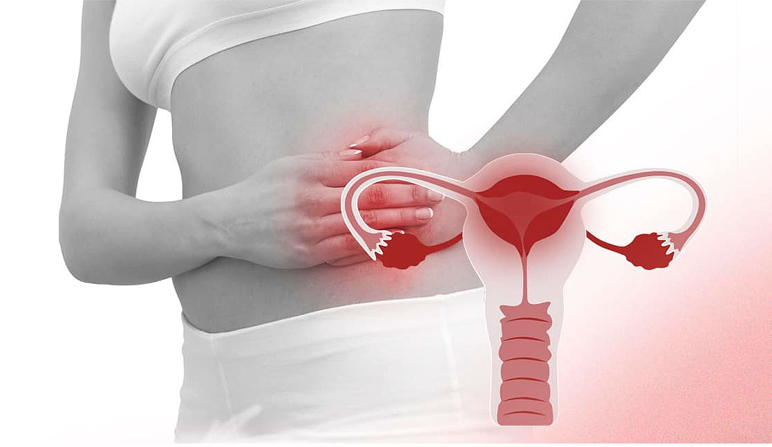 بیماری التهابی لگن (Pelvic inflammatory disease) 