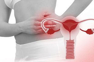 بیماری-التهابی-لگن-(Pelvic-inflammatory-disease)