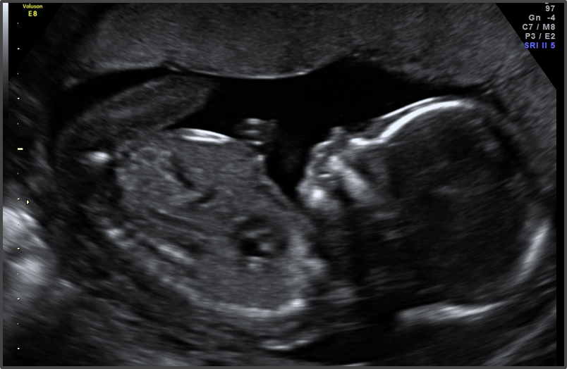 سونوگرافی هفته 16 بارداری